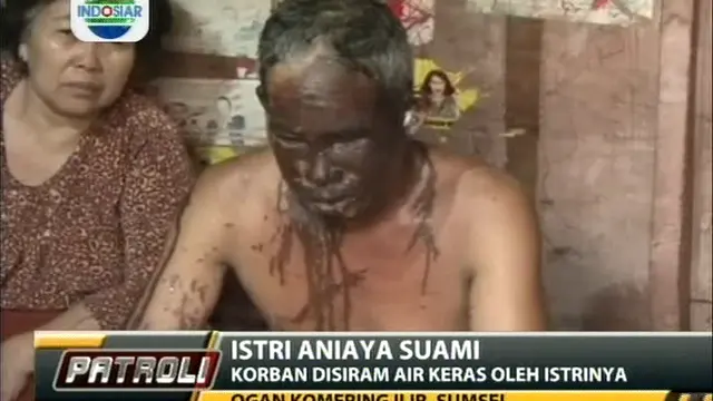 Istri Aniaya Suami, Korban Disiram Air Keras Oleh Istrinya