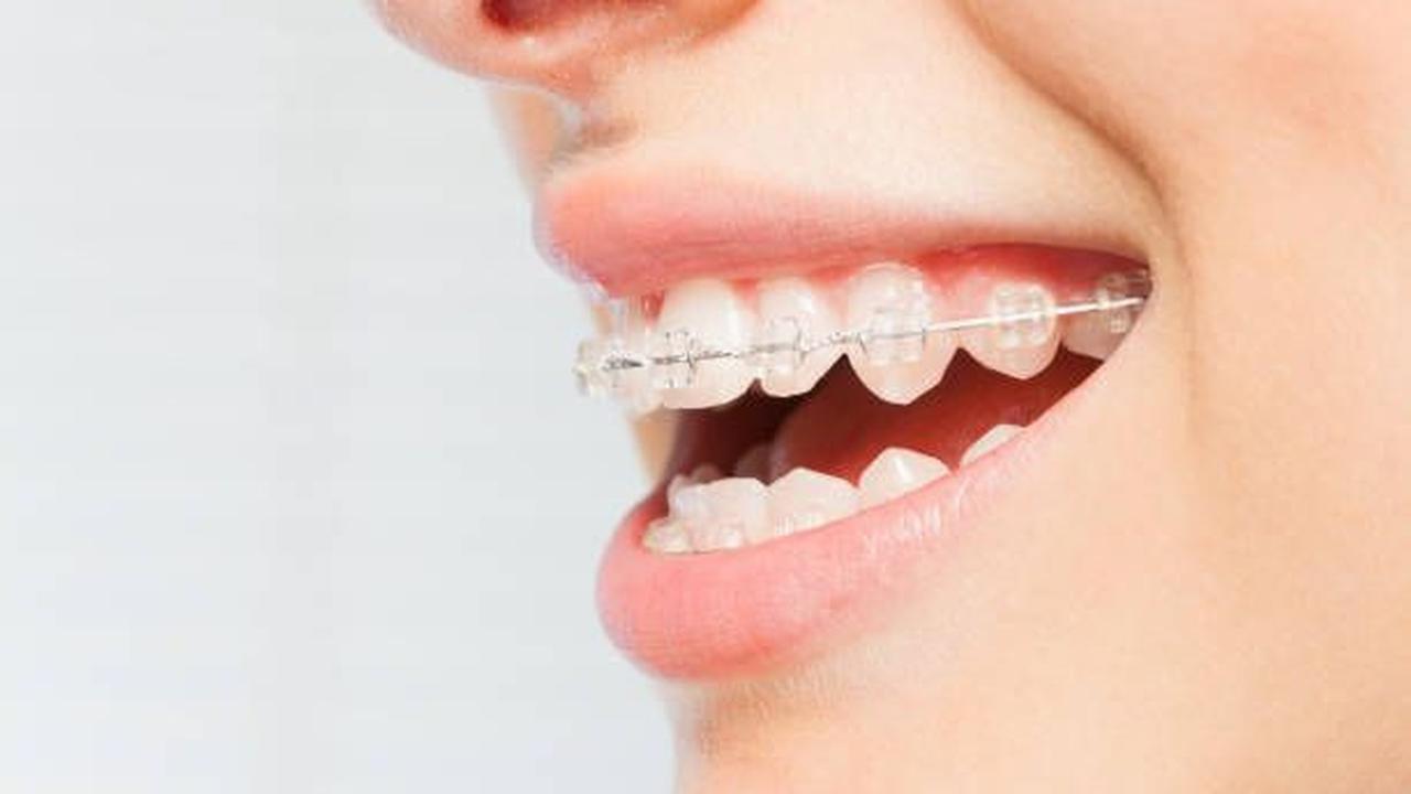 2. Behel Transparan (Clear Braces)<br>