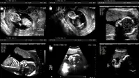 Bayi di dalam rahim dari hasil MRI. (Foto: Today's Parent)