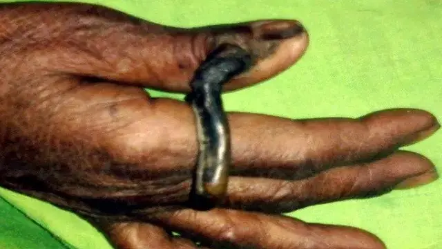 Tanduk yang muncul di ibu jari wanita itu