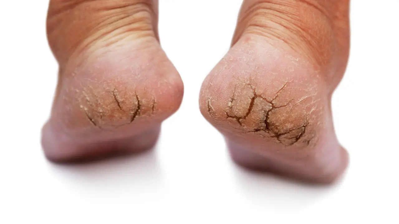 Cara Merawat Kaki Pecah-pecah