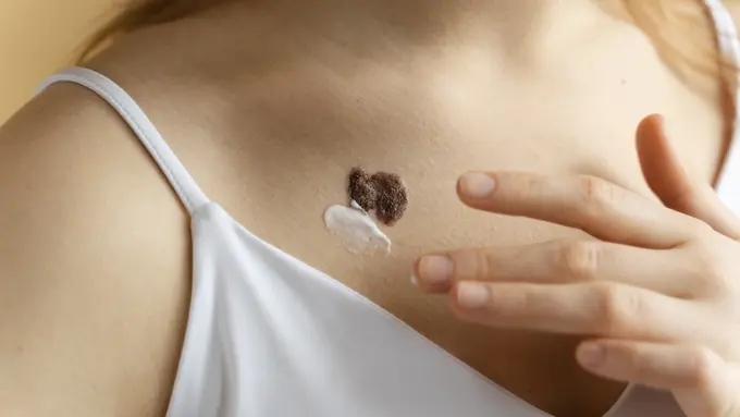 Cara Menghilangkan Keloid Secara Aman