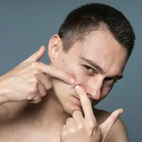 Ilustrasi jerawat/Coptright Freepik/Freepik