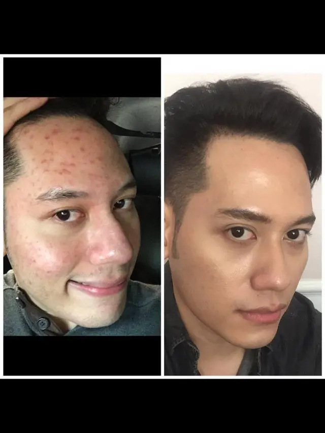 Black Mask Laser Treatment