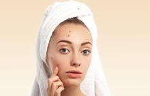 Jerawat Hilang Tanpa Skincare? Ini 9 Cara Alami yang Bisa Dicoba