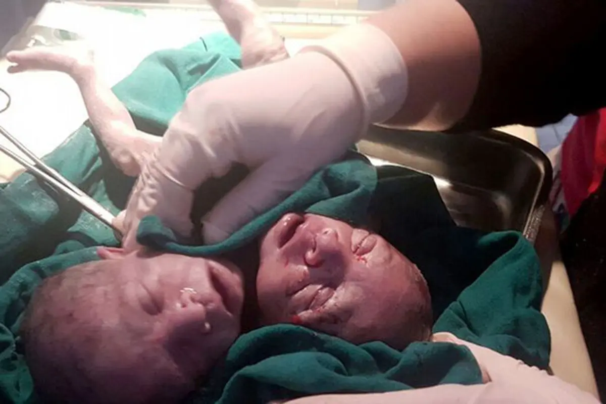 Tragis, Nasib Bayi yang Lahir dengan 2 Kepala