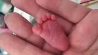 Meski lahir secara prematur dan sangat mungil, untungnya bayi ini bertahan hidup