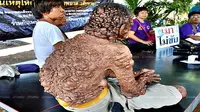 Tumor Selimuti Tubuh dan Wajah, Sudjai Berjuang Membuka Matanya 