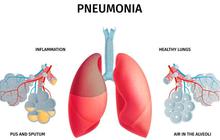 Lima Langkan Cegah Peradanngan Paru-paru Akibat Pneumonia