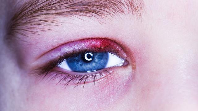 Penyebab Mata Bintitan serta Cara Mengobati dan Mencegahnya, Perhatikan Kebersihan