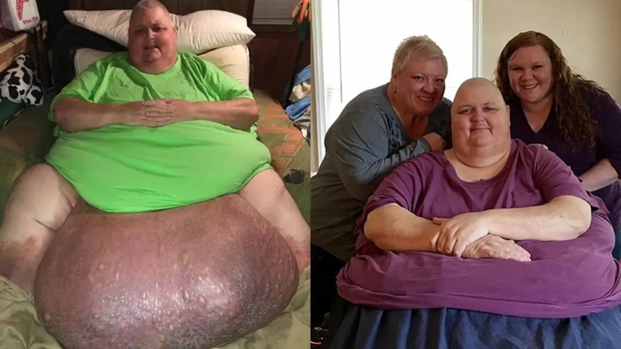 Dikira Lemak Karena Kegemukan, Tumor 57 Kg Akhirnya Dioperasi