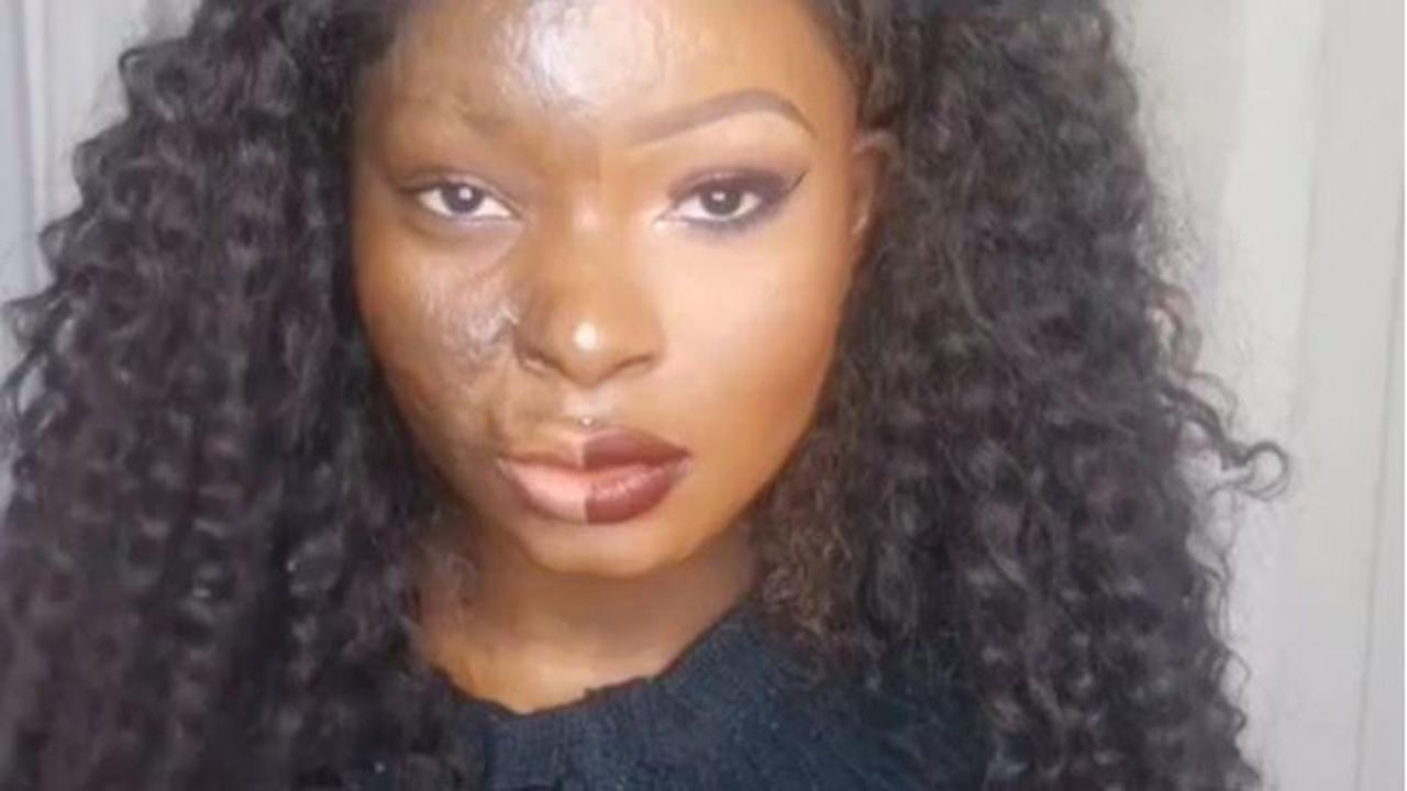 Wanita dengan Luka Bakar di Wajah