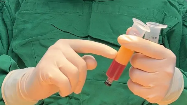 Perawatan kecantikan Fat Filler