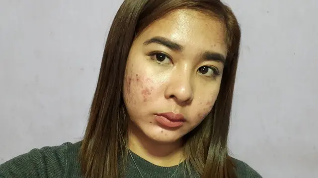 [Bintang] Dibully karena Jerawat, Wanita Ini Tampar Netizen dengan Jawaban Tegas