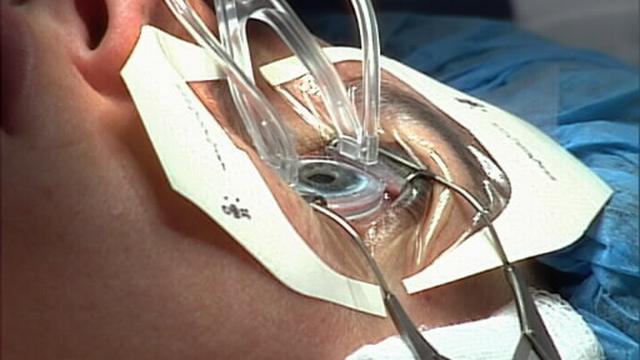 Teknik Laser Operasi Kornea Tanpa Jahitan Health Liputan6 Com