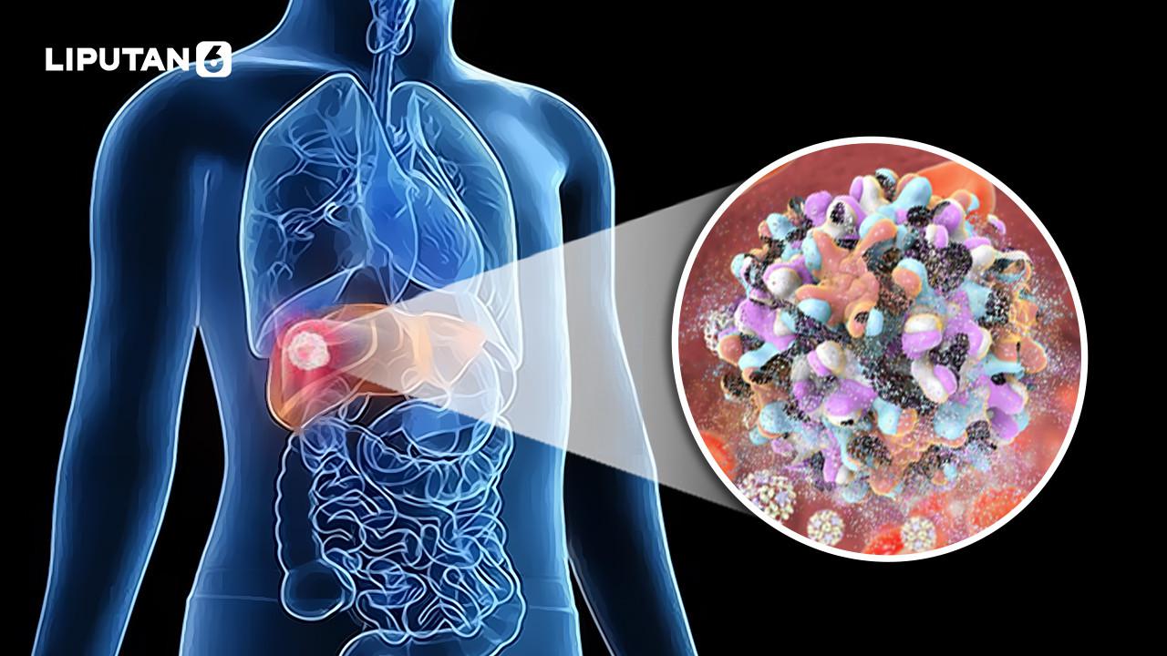Hepatitis Akut Mengancam, Bagaimana Antisipasinya?
