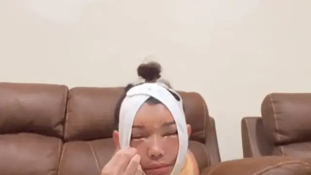 Wajah Bunda Corla Usai Oplas
