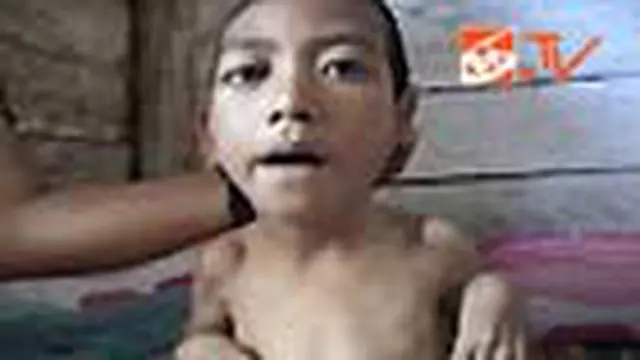 Bocah Miskin Butuh Perawatan Dokter