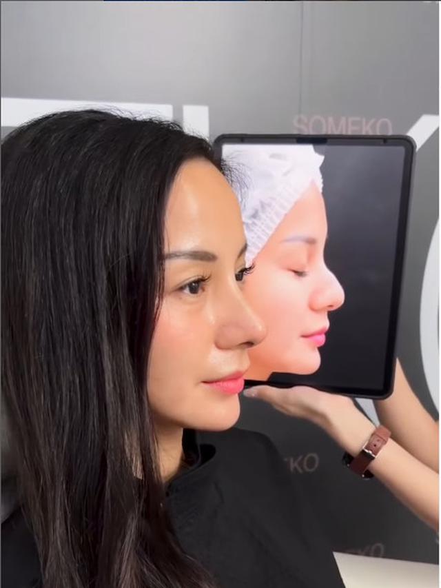 6 Potret Terbaru Kirana Larasati Usai Rhinoplasty, Akui untuk Estetika