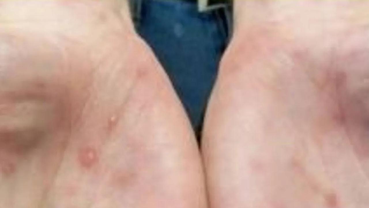 Menkes soal Cacar Monyet: Penularannya Lewat Seksual