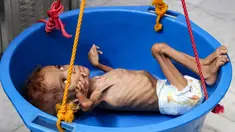 Seorang bocah yang menderita gizi buruk ditimbang di rumah sakit di Distrik Abs, Provinsi Haji, Yaman, Rabu (19/9). Konflik berkepanjangan antara pemerintah Yaman dengan pemberontak Houthi mengakibatkan 5,2 anak terancam kelaparan akut. (ESSA AHMED/AFP)