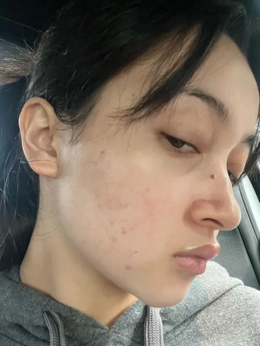 Adik Bryan Domani ini mengaku punya riwayat panjang dengan jerawat di bagian wajahnya. [Instagram @megandomani1410]