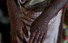 CEK FAKTA: Hoaks Virus Mpox Disebabkan karena Efek Samping Vaksin Covid-19
