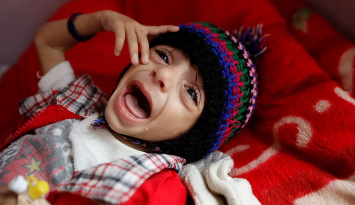 Seorang anak menangis saat dirawat di rumah sakit di Sanaa, Yaman pada 26 September 2016. Bangsal perawatan intensif di rumah sakit Yaman dipenuhi dengan anak-anak malnutrisi. (REUTERS/Khaled Abdullah)