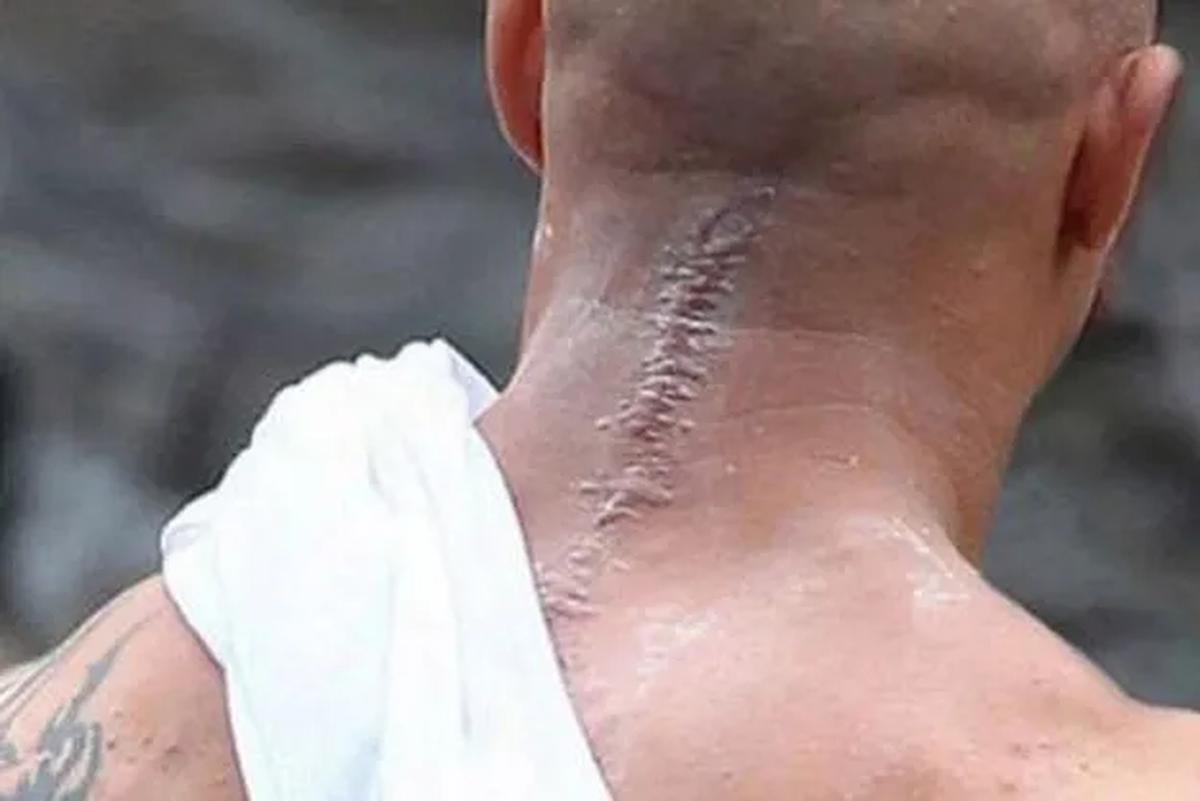 Luka parut yang ada di punggung leher Bane.
