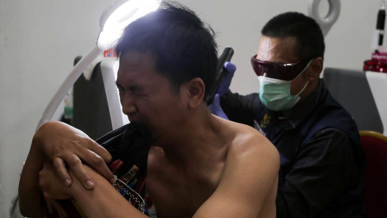 Layanan Hapus Tato Gratis di Jakarta