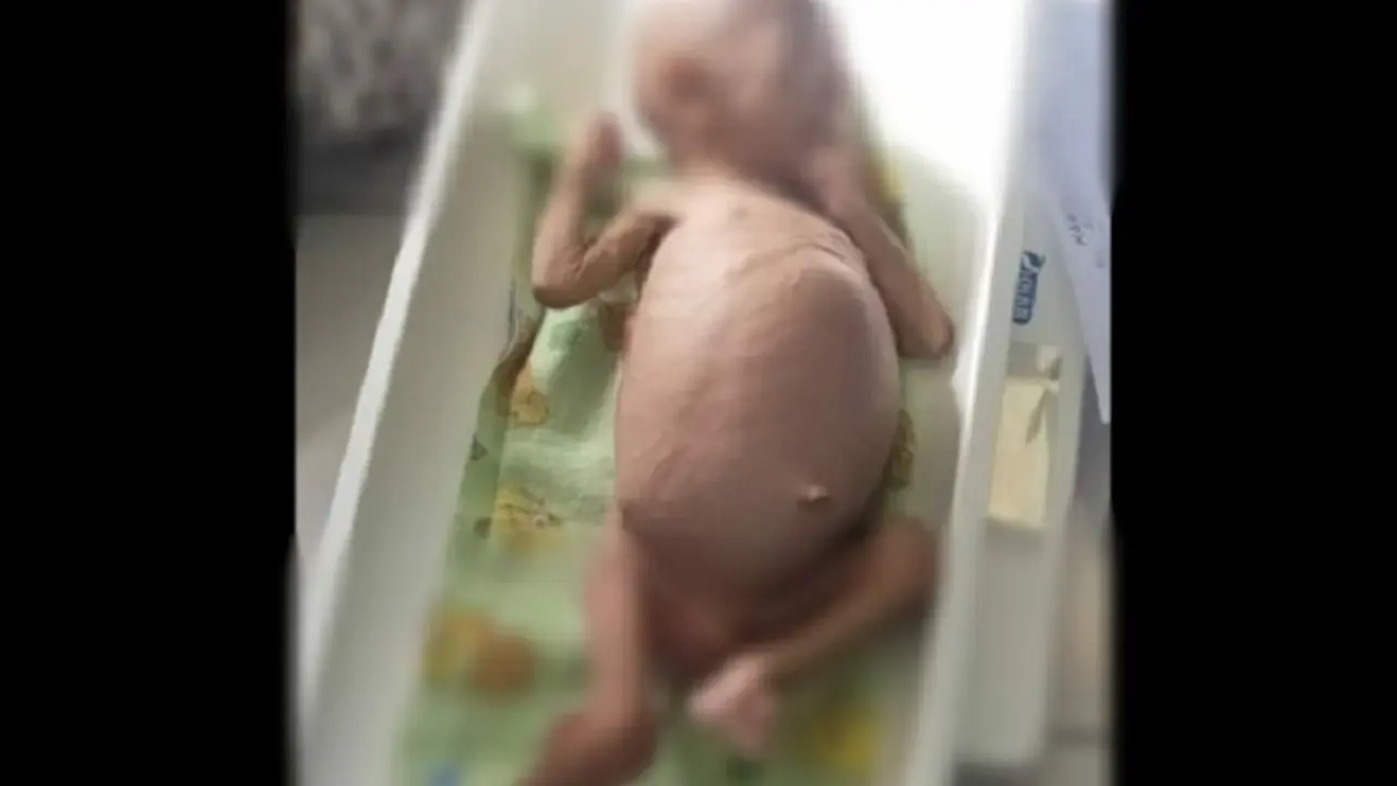 Bayi Menderita Gizi Buruk
