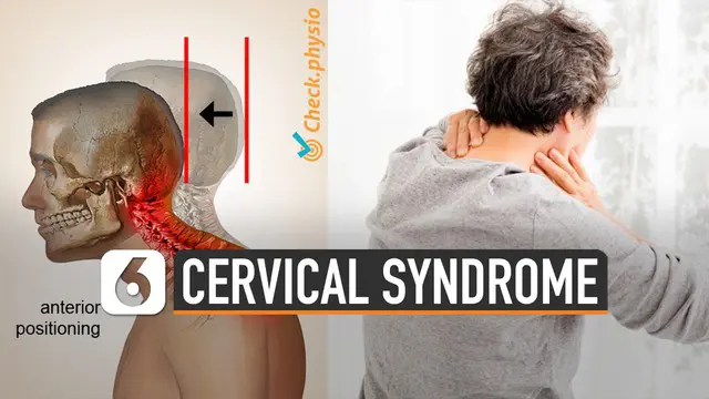 Cervical syndrome, gangguan yang disebabkan perubahan tulang belakang dan jaringan lunak yang mengelilinginya.