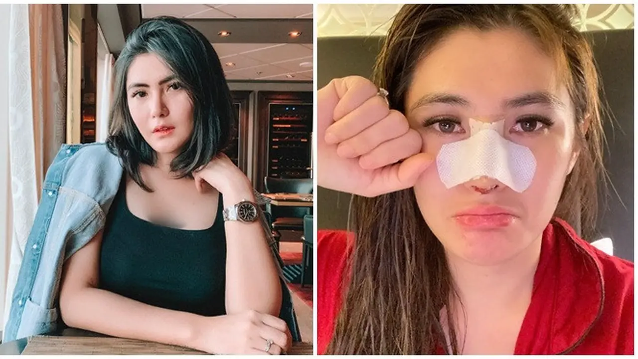 8 Selebriti Indonesia yang Lakukan Opersi Hidung, Terbaru Angela Lee