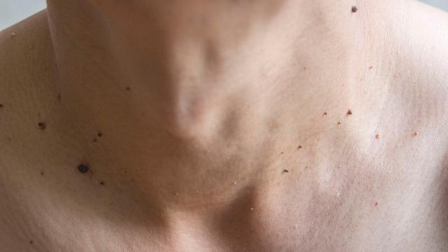 Memiliki Banyak Tahi Lalat, Haruskah Khawatir?