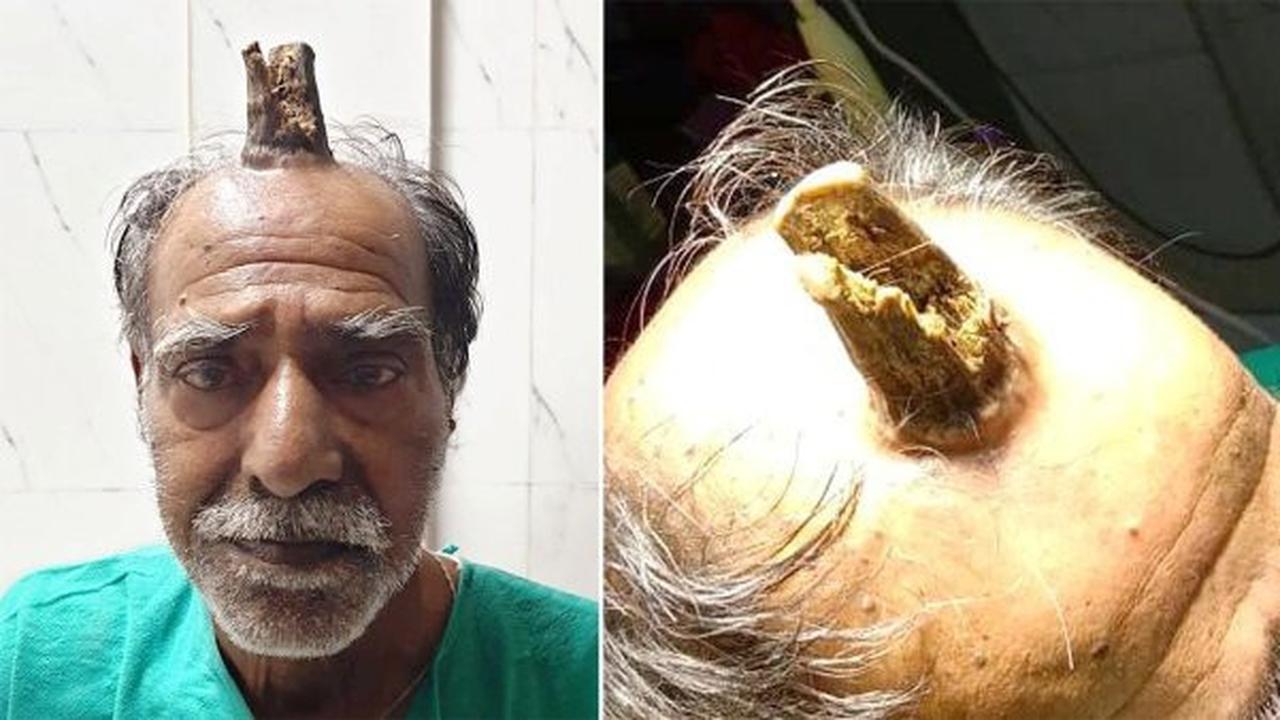 kakek di India miliki tanduk