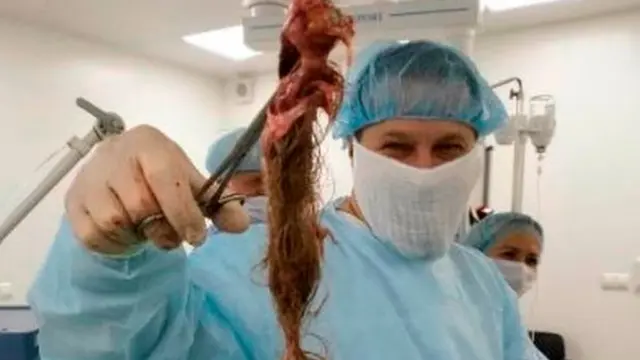 Mengeluh Sakit Perut, Dokter Temukan Kista Berisi Gumpalan Rambut dari Indung Telur Wanita Ini