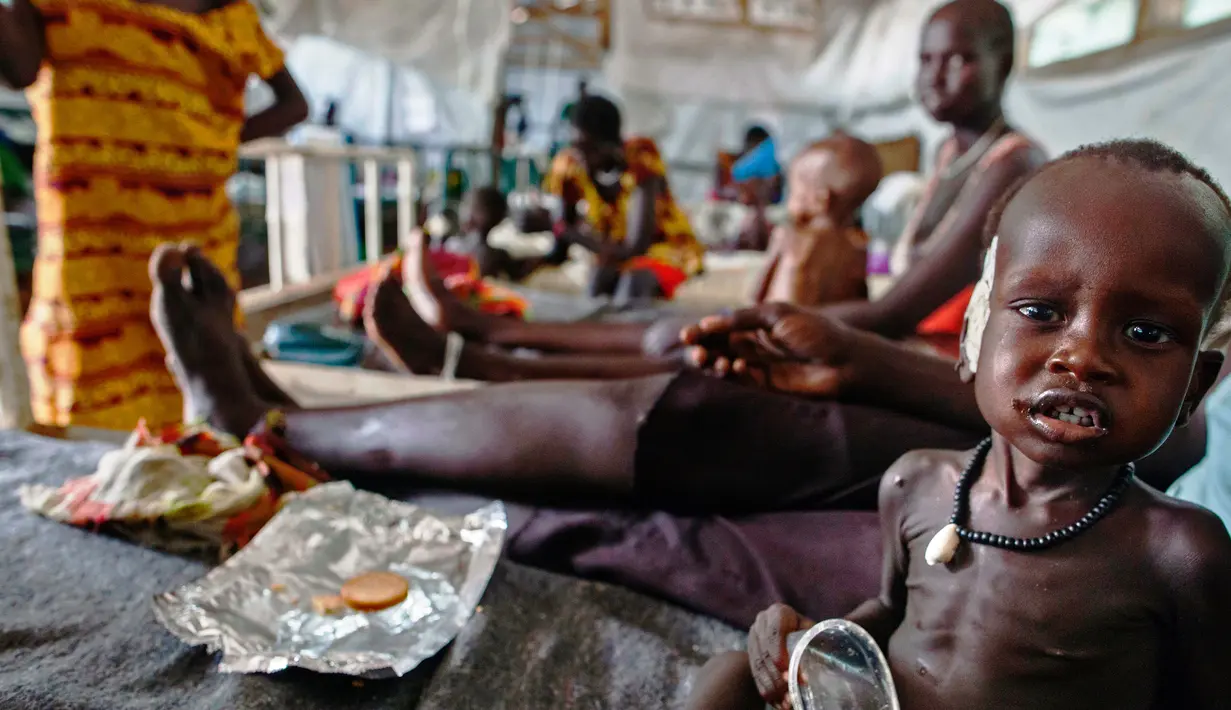 Seorang anak tampak kurus akibat gizi buruk yang ia alami di sebuah klinik di Lankien, Sudan Selatan, (8/4).Tingkat kelaparan di Sudan selatan memang sangat mengkhawatirkan. (Albert Gonzalez Farran / cds / AFP)