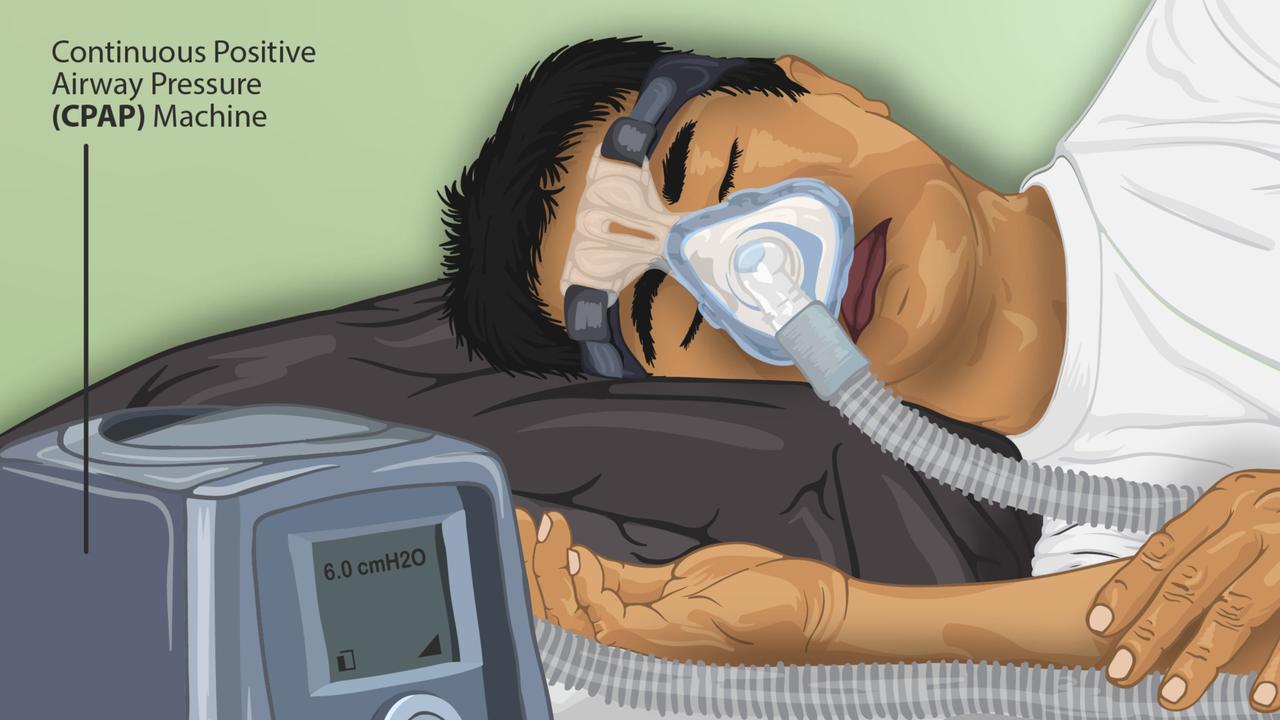 Pengobatan Sleep Apnea