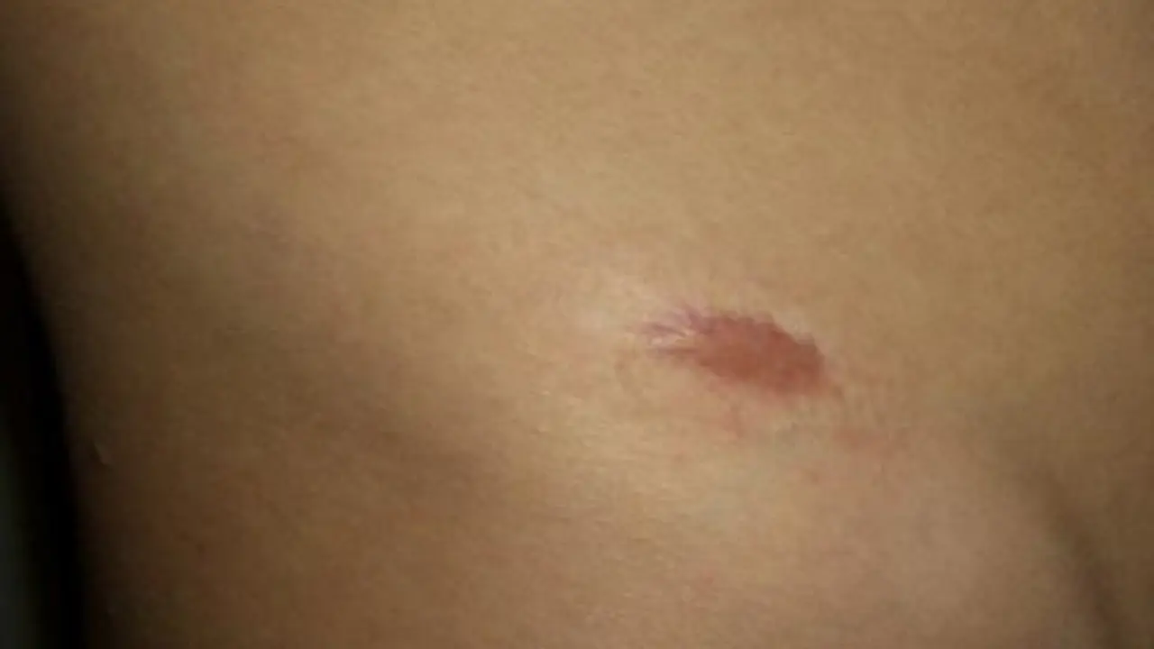 Keloid