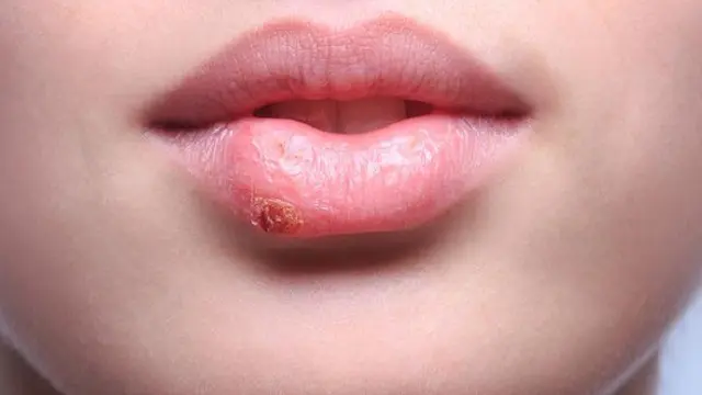 herpes