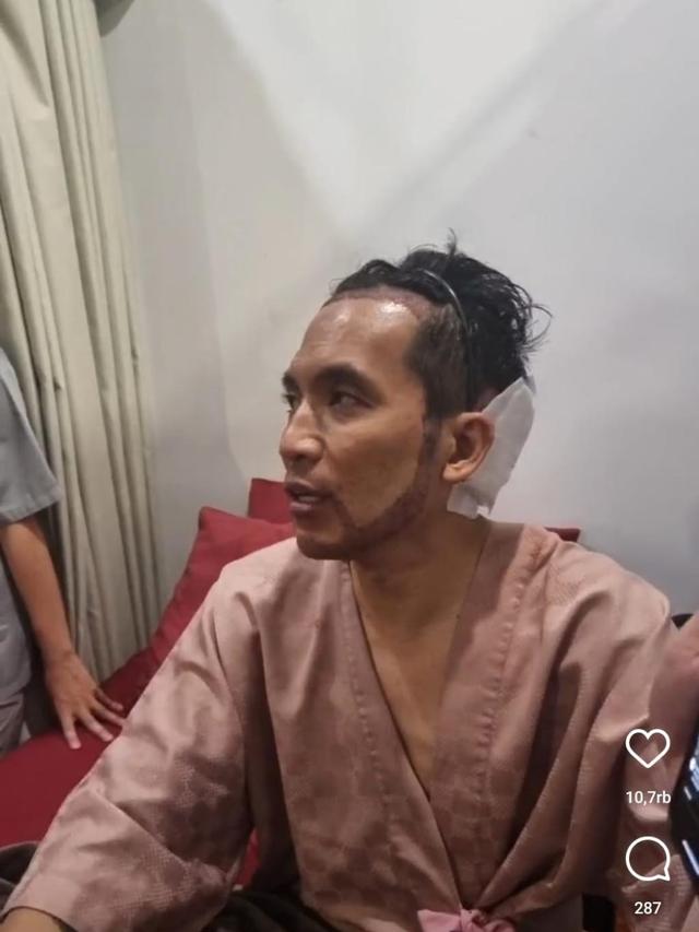 Desta jalani transplantasi rambut. (Instagram/ beyoutifulhairtransplantcenter)