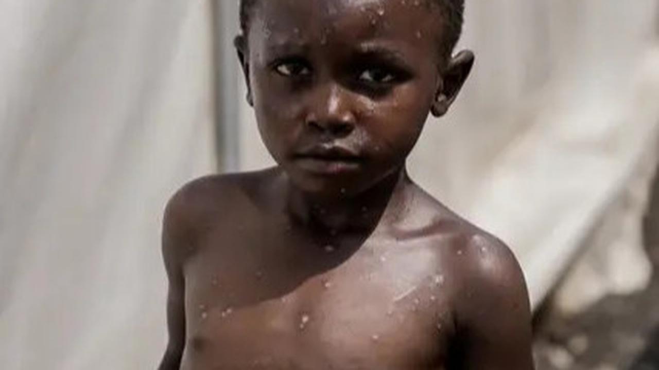 Mpox Bakal Jadi Ancaman Global Baru? Kenali Gejala, Penularan, dan Upaya Pencegahannya