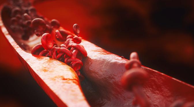 Aterosklerosis/Shutterstock.