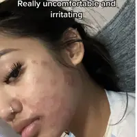 Kulit mulusnya hilang akibat kuas makeup yang kotor dan sebabkan jamur di wajahnya. (Foto: Tiktok/ Louaira)