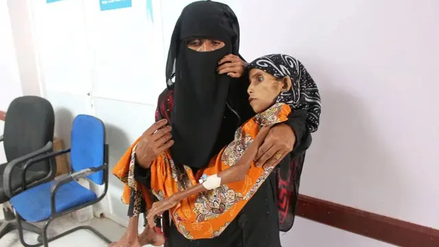 Kisah Pilu Gadis Malnutrisi Korban Perang