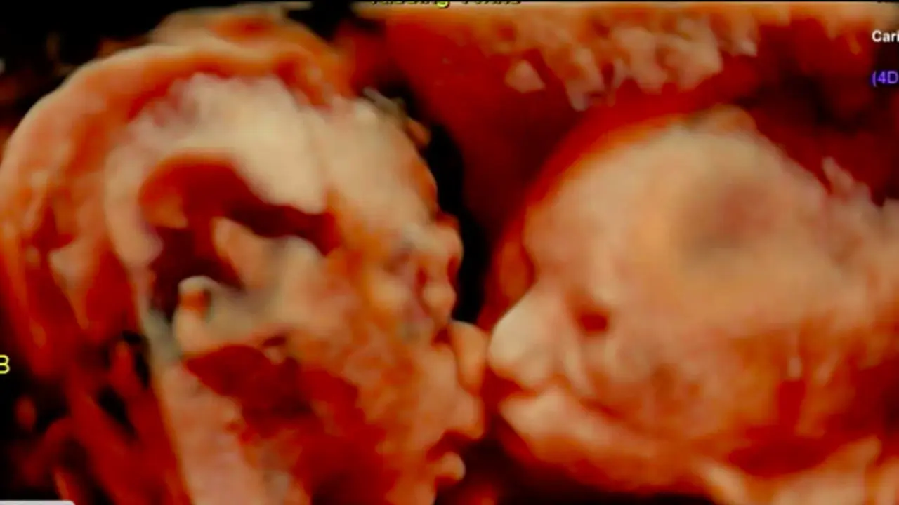 Ajaib, Bayi Kembar Terlihat Berciuman Saat di USG