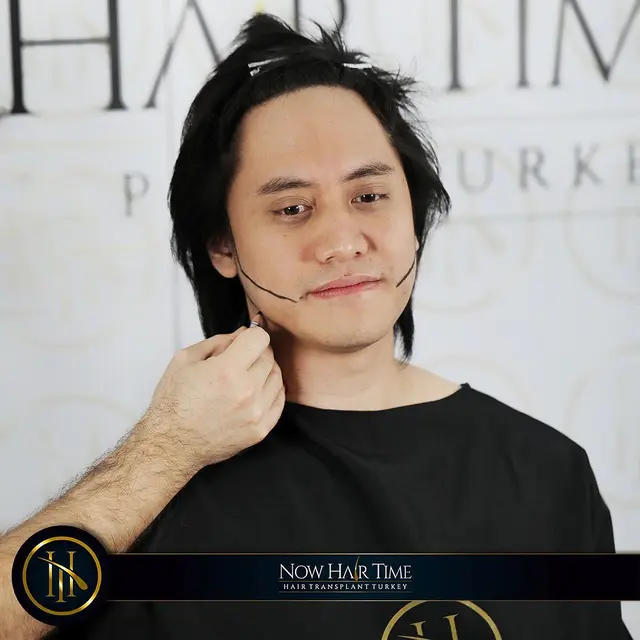 Potret Kevin Aprilio Jalani Transplantasi Rambut. (Sumber: Instagram/now.hairtime)