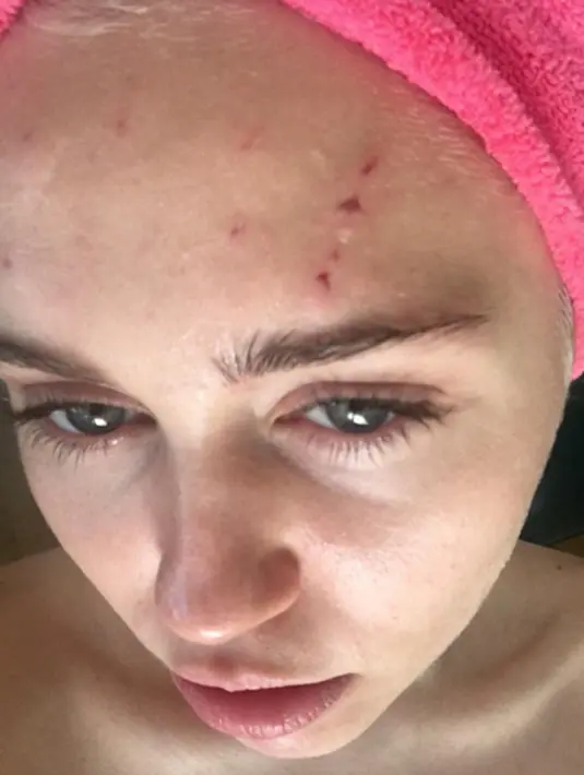 Selain itu bagian dahi Miley Cyrus terdapat cakaran dari kucing itu, bahkan dalam foto yang di unggah Miley bekas cakara tersebut masih mengeluarkan darah. (viainstagram@mileycyrus/Bintang.com)