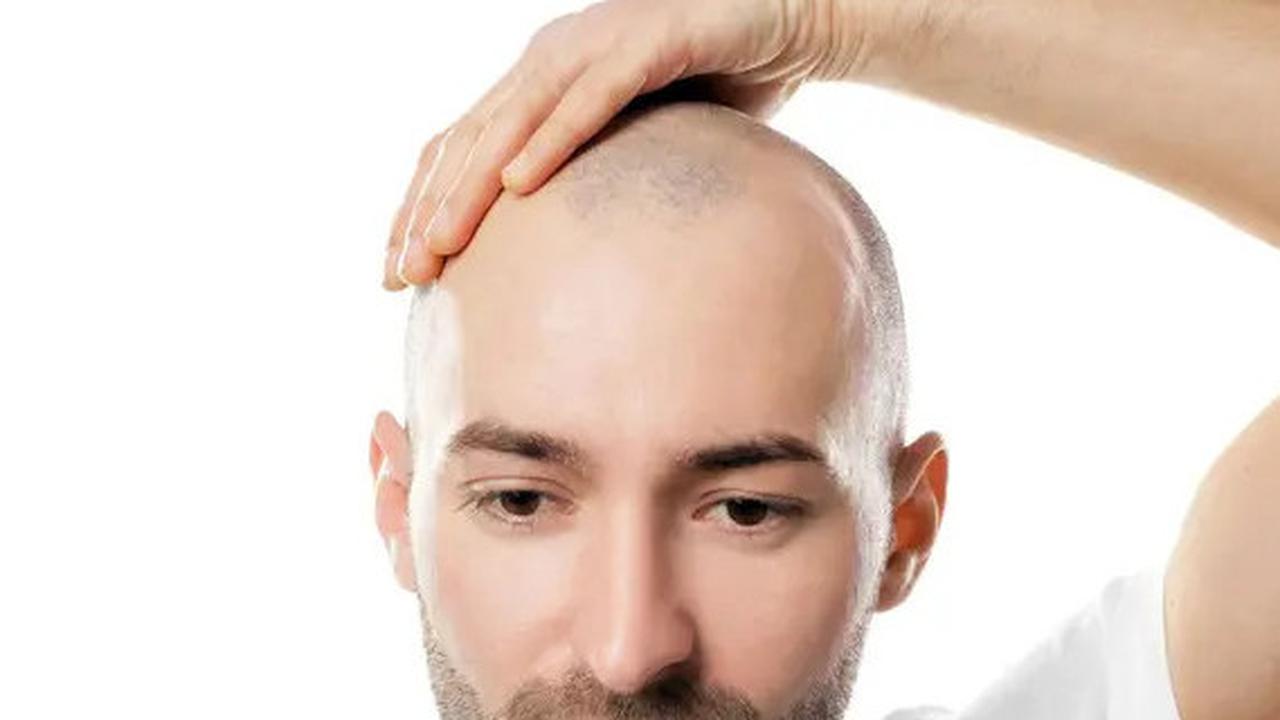 12 Cara Mencegah Rambut Menipis dan Menjadi Botak