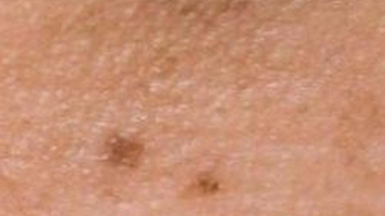<b>Penyebab Flek Hitam di Wajah</b>